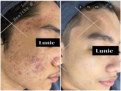 SỰ LỘT XÁC NGOẠN MỤC CỦA KHÁCH SAU CA ĐIỀU TRỊ MỤN TẠI LUNIE tại Quảng Nam