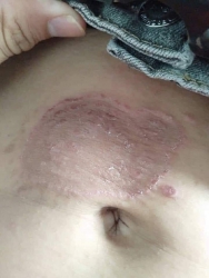 Chữa bệnh nấm ngứa, viêm da cơ địa, dị ứng xi măng, hắc lào, lang ben, tổ đỉa, nấm da đầu, á sừng, ghẻ lở, nấm móng tay chân tại Quảng Nam