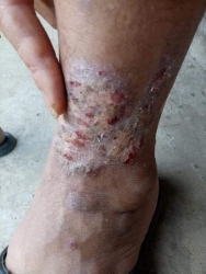 Chữa bệnh H.ắc lào, lang ben, ghẻ nước, tổ đỉa, nấm ngứa, viêm da cơ địa tại Quảng Nam