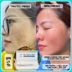 Meso không tiêm 2Nine chuẩn Hàn Quốc tại Quảng Nam