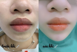 Filler giảm giá 30% tại Quảng Nam