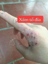 Tổ đỉa hay còn gọi là ghẻ nước tại Quảng Nam