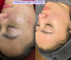 BỘ NÁM MELA SKIN 2NINE tại Quảng Nam