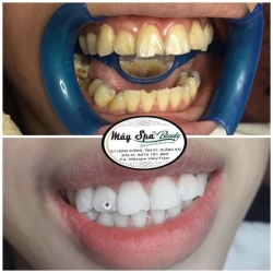 Răng Trắng Xinhh - Lưới Lì Moi Khưng Hình tại Quảng Nam