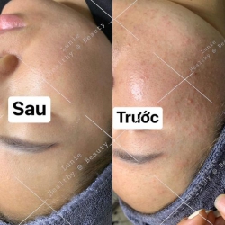 Điều trị mụn chuẩn y khoa - Kết quả sau liệu trình tại Quảng Nam