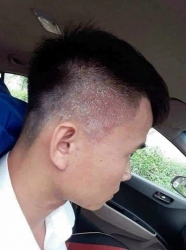 Chỉ 1 liệu trình thuốc khỏi vĩnh viễn tại Quảng Nam