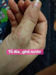 Thuốc chống ngứa dứt điểm tại Quảng Nam