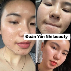 Chemical Peel hay còn gọi là Peel tại Quảng Nam