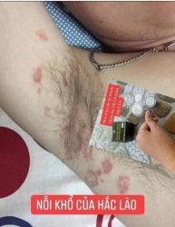Hồ sơ: HẤC LÀO Ngứa điên đảo tại Quảng Nam