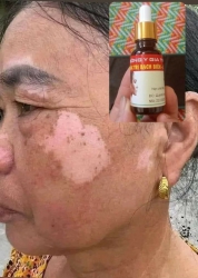 Đặc trị bạch biến lang ben Chỉ cần 1 lo trị dứt điểm trong 10 ngày Ai cần ib nhe. Cam kết 100% tại Quảng Nam