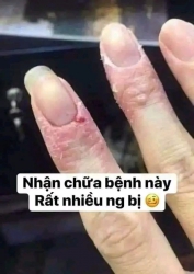 Tổ đỉa hay còn gọi là ghẻ nước tại Quảng Nam