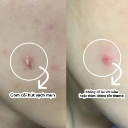 Sản phẩm Mặt Nạ Cơ Địa hàn quốc Coothing Mask Master Patch - Cực chất từ chối mụn viêm tại Quảng Nam