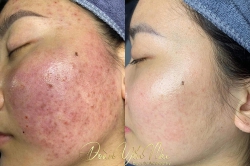 Loại bỏ mụn không tự biến mất mà cần làm sạch filler! tại Quảng Nam