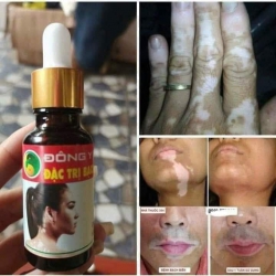 Đặc trị bệnh bạch biến lang ben tại Quảng Nam