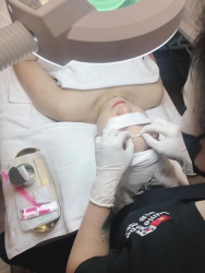 Liên tục tuyển mẫu lấy nhân mụn miễn phí tại Quảng Nam