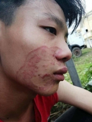 Chữa trị vĩnh viễn các bệnh da tại Quảng Nam