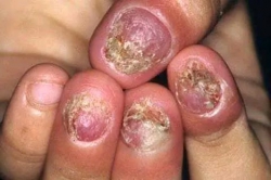 Điều trị các bệnh nấm và viêm da tại Quảng Nam