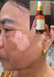 Đặc trị bạch biến lang ben Chỉ cần 1lo trị dứt điểm trong 10 ngày Ai cần i.b nhe tại Quảng Nam