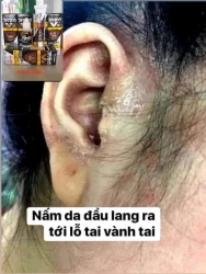 Điều trị Nấm vảy nến tại Quảng Nam