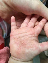 TỔ ĐỈA hay còn gọi là GHẺ NƯỚCCàng gãi càng lan rộng raGãi bọng nước bể tới đâu lan tới đóAi bị như tại Quảng Nam