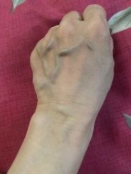 Nhà có ai bị suy dãn tĩnh mạch không ạ Đau nhức mệt mỏi Gân xanh nổi nhiều Hay bị chuột rút Ib em tại Quảng Nam