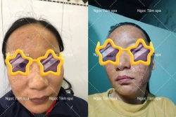 m bong đẹp ngày thứ 4 và ngày thứ 5 sau 1 lần làm kĩ thuật tại Quảng Nam