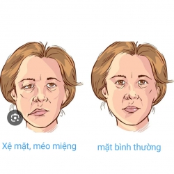 Phòng khám VLTL Tâm Trí điều trị Liệt dây thần kinh số 7 tại Quảng Nam