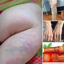 Thuốc trị dứt điểm bệnh Suy Giãn Tĩnh Mạch tại Quảng Nam