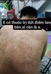Đặc trị bạch biến lang ben tại Quảng Nam