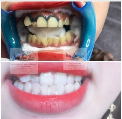 Muốn Răng Trắng Như Dừa Thì Qua Nhà Mâyspa Điện Bàn tại Quảng Nam