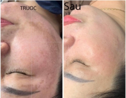 BỘ NÁM MELA SKIN CAO CẤP - HÀN QUỐC CHUYÊN TRỊ NÁM tại Quảng Nam