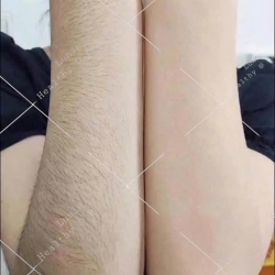 Triet long Lunie spa tại Quảng Nam