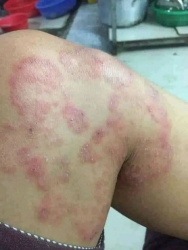 Ngứa càng gải càng ngứa tại Quảng Nam