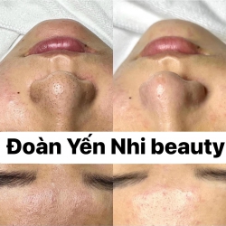 SẠCH TỪNG LỖ CHÂN LÔNG - DA CĂNG BÓNG HỒNG HÀO tại Quảng Nam