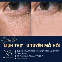Dịch vụ trị mụn thịt tại Dr Ngọc Anh tại Quảng Nam