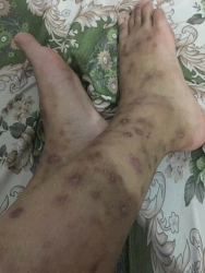 Kem điều trị sẹo thâm, ngứa tay chân tại Quảng Nam