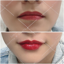 Một đôi môi nhiều nếp nhăn cân chỉnh tại Lunie Spa Vĩnh Điện tại Quảng Nam