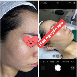 Hãy đến với HOA NGUYEN SPA để giải quyết vấn đề mụn của bạn tại Quảng Nam