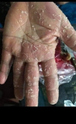 Trị dứt điểm nám làn da tại Quảng Nam
