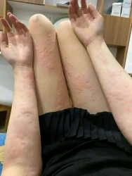Nổi mề đay - Dị ứng nắng mưa nóng lạnh tại Quảng Nam