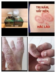 Thuốc Nam Trị Bệnh #hắclào #ngứa #tổ_đỉa tại Quảng Nam
