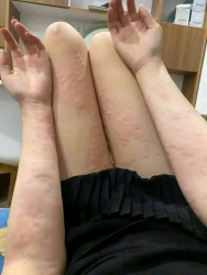 Cách chữa dứt điểm dị ứng mề đay thời tiết tại Quảng Nam
