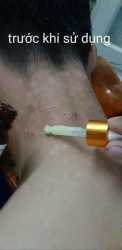 Đặc trị bạch biến lang ben tại Quảng Nam