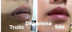 Dịch vụ Khử Thâm Làn Môi Tại Ngọc Tâm Spa tại Quảng Nam