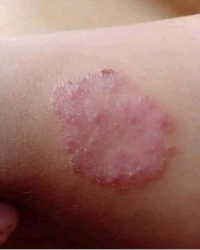 Chữa viêm da cơ địa không tái phát tại Quảng Nam