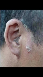 Đặc trị Nấm vảy nến Chỉ cần 1 lọ trị dứt điểm Ai cần i.b nhe tại Quảng Nam