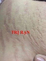 Kem trị sẹo Nga bất chấp các thể loại sẹo tại Quảng Nam