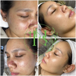 Kết quả điều trị mụn nám và sẹo tại spa Hoa Nguyên tại Quảng Nam