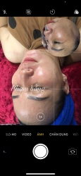 Vi kim rải hạt- công dụng căng bóng, trẻ hoá da tại Quảng Nam
