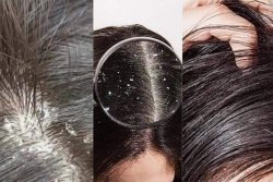 Sản phẩm Dầu Gội Đặc Trị Gàu Clinical Strength 400ml tại Quảng Nam